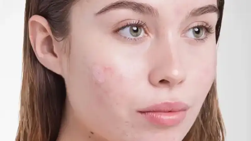 Acne or Pimple Marks on the Skin